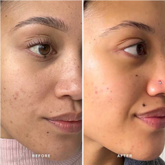 Before and after comparison of a woman's face with visible skin texture changes.