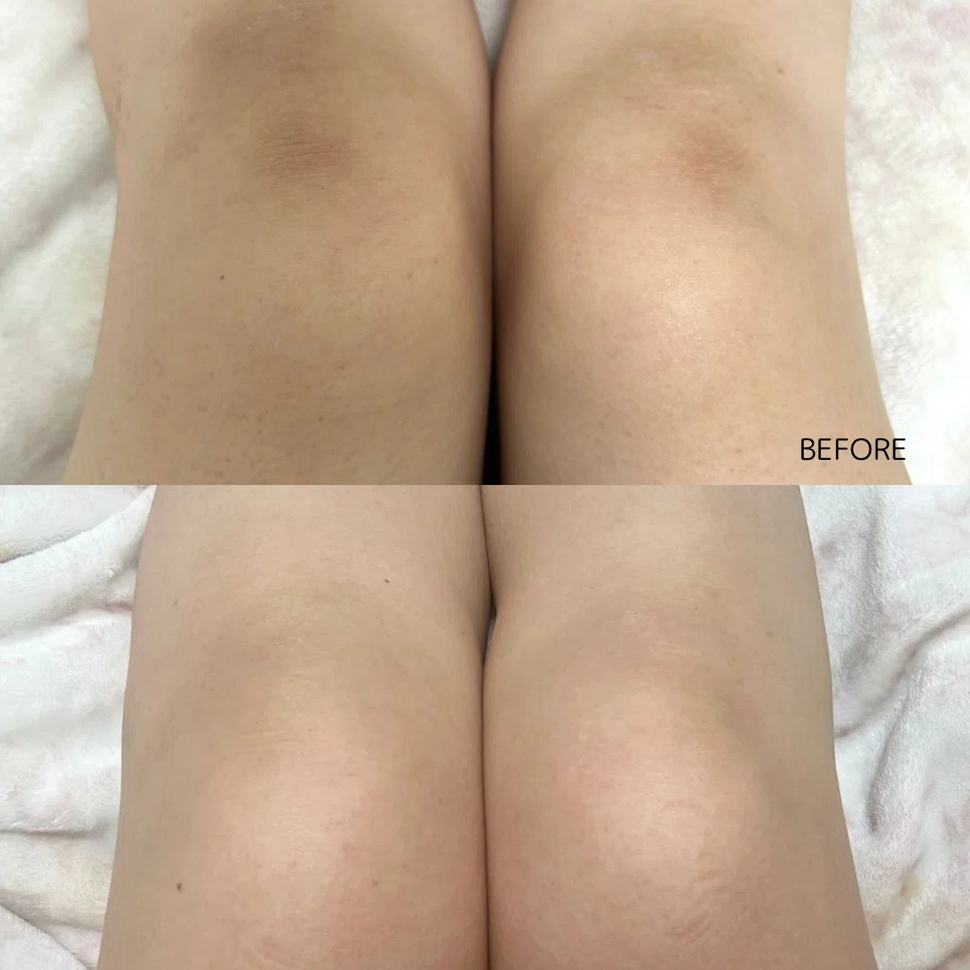 Before and after comparison of legs with visible skin texture on a light background.