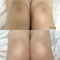 Before and after comparison of legs with visible skin texture on a light background.